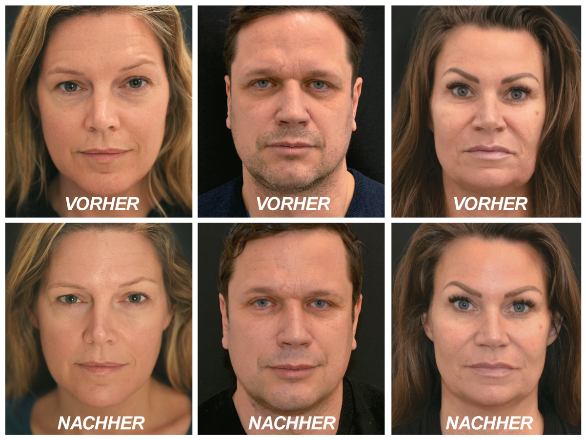 Infuzion Vorher/Nachher