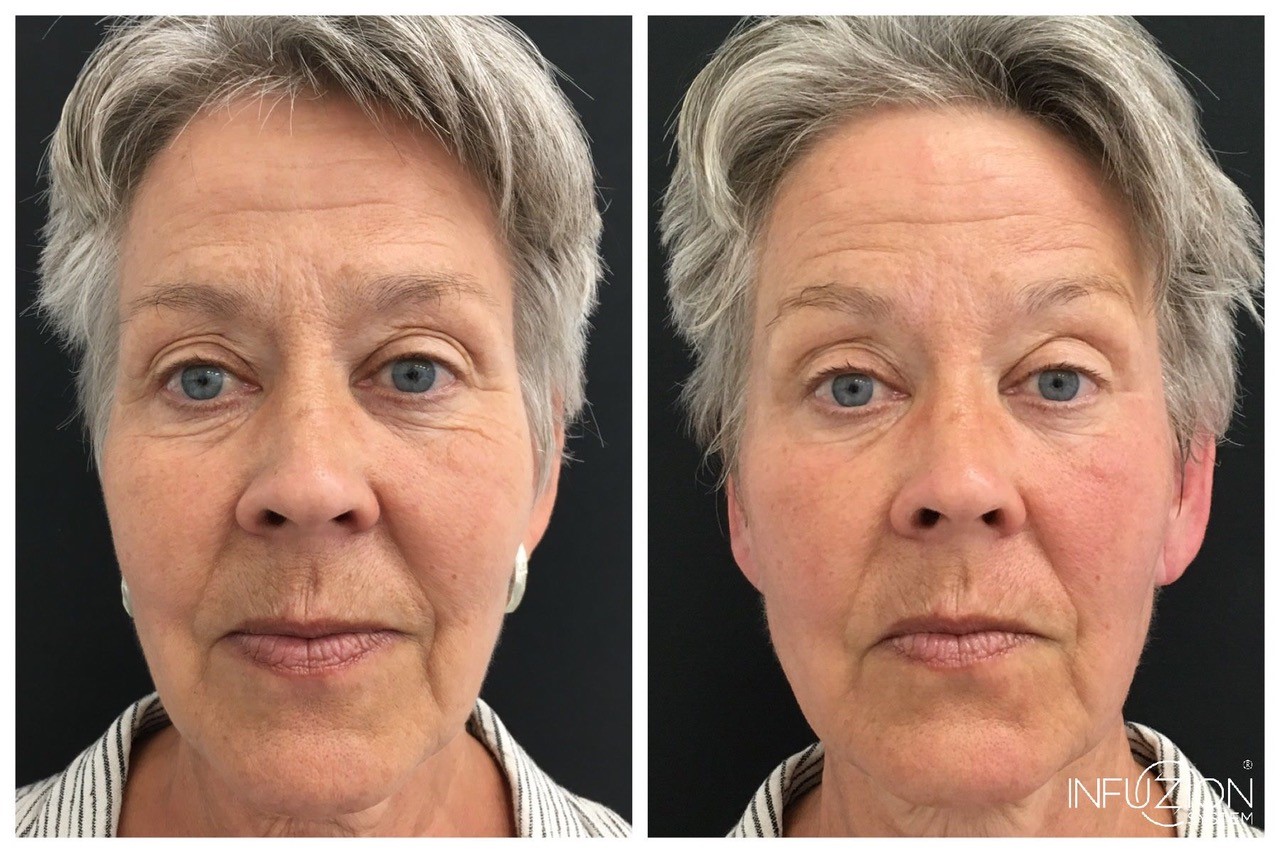 Infusion Frau Gesicht